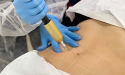 $480 for Non-Invasive Fat Dissolver with Hyaluron Pen at Embracing Her Beauty ($600 Value)