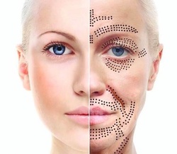FibroBlast Lift Treatment on Small, Medium, or Large Area at Twins Beauty (Up to 63% Off)