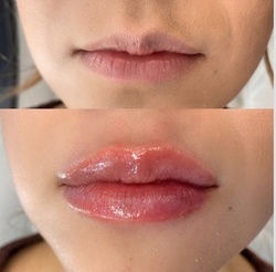 $325 for One Hyaluronic Acid Filler for Lips at Luminous Nail Bar ($389 Value)