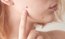One or Two Laser Pigmentation-Removal Sessions on Full Face at Simin Aesthetic Laser (Up to 67% Off)