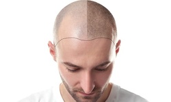 One Scalp or Scar Micro-Pigmentation Session at INKredible Scalp Micropigmentation (Up to 65% Off)