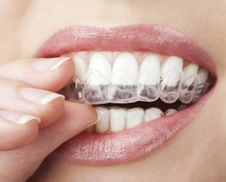 Up to 92% Off on Braces - Invisible - Branded (Invisalign) at Hudson Dental Center West New York
