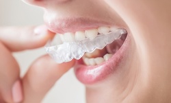 $39 for $1,500 Value Towards Full Invisalign Treatment at Midtown Dental Group 