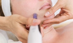 One or Three Fractional RF Microneedling Sessions at Jenny Skin Care (Up to 45% Off)