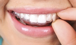 $197 for $2,000 Toward Invisalign Treatment at Magnolia Family Dental