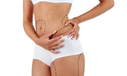 1, 6, 8, or 12 30-Minute 3D Laser-Lipo Sessions at Luxuries by Lakay (Up to 38% Off)