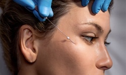 PDO Thread Lifts Performed by a Board Certified Physician at Forever MedSpa & Wellness Center (Up to 43% Off)