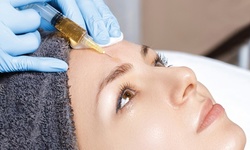 One or Three Full Face PRP Filler Injections at EternaMD (Up to 58% Off)
