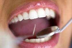 Up to 90% Off on Dental Filling at LifeSmiles Dental Care