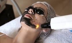 $156 for One Carbon Laser Facial Treatments with Silk Mask at Sarah Laser Medspa ($500 Value)
