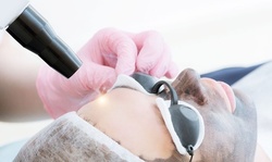 One Carbon Laser Peel Treatment with Optional LED Therapy at Laser-Esthetics (Up to 50% Off)
