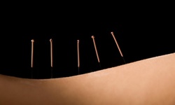 Up to 72% Off Acupuncture  at Wise Wellness