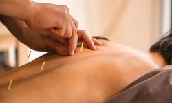 One, Three, or Five Acupuncture Treatment with Optional Cupping at Soft Touch Acupuncture (Up to 88% Off)