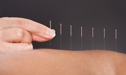 Acupuncture Treatment with Optional Cupping or Massage, or Facial Acupuncture at Acu Health Care (Up to 68% Off)