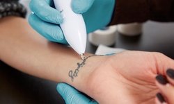 Three Tattoo Removal Treatments for 5, 10, or 15 Square Inch Area at Reddy Aesthetics (Up to 85% Off)
