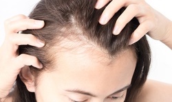$260 for One Women's Scalp Micropigmentation Session at Scalp Ink Design ($799 Value)