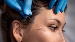 One PDO Thread Lift or Bi-Dimensional MINT PDO Thread Lift at ReNuMe Medspa (Up to 49% Off)