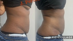 Up to 50% Off on Cavitation at J. Perfected