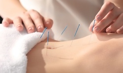 Exam with Consultation and Five or Ten Dry Needling at Chiropractic Professionals Of Columbia (Up to 63% Off)