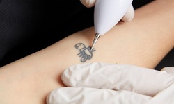 Three Sessions of Laser Tattoo Removal at Westchester Laser Associates (Up to 79% Off). Three Options Available.