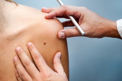 One, Two, or Three Electrolysis Mole or Skin-Tag Removal Treatments at  Beauty Spa Soho (Up to 53% Off) 