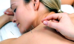 One or Two Acupuncture Sessions at JCB Acupuncture (Up to 75% Off)  