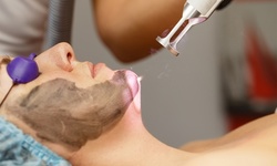 One or Two Carbon Laser Peels with LED Treatment at Labelle MedSpa (Up to 60% Off)