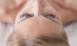 One, or Three AcuFacial Treatments at AcuFacials (Up to 25% Off) 