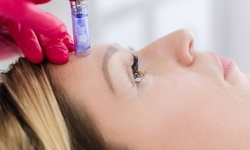 One or Three Microneedling Treatments at Nush Skincare (Up to 35% Off)