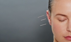 One Acupuncture Session with Consultation at Ke Jin's Acupuncture & Herbal Clinic (Up to 63% Off)