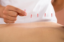 Up to 61% Off on Acupuncture Services at Wellington Acupuncture Massage Cupping