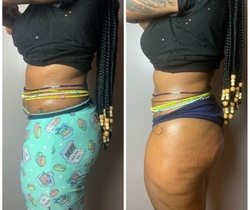 Up to 28% Off on Gluteoplasty / Butt Lift - Non-Surgical at Sol Transformations