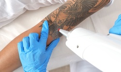 Three Tattoo-Removal Sessions on One Small, Medium, or Large Area at Euro Image Med Spa (Up to 84% Off)