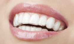 Invisalign Package with Teeth Whitening at Design Dental Group, 97% Off