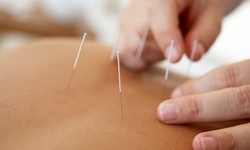 $45 for One 45-Minute Full-Body Customized Acupuncture Session at Nuvo Aesthetic & Wellness ($150 Value)