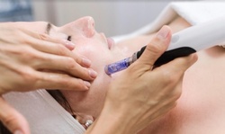 Microneedling Treatment for the Face and Optionally Neck at Kalologie Medspa (Up to 80% Off)