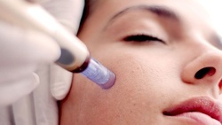 Up to 40% Off on Micro-Needling at Lotus Health And Aesthetics Spa