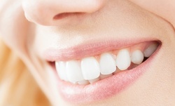 Up to 60% Off on Teeth Whitening - Traditional at I Am Beautique Body Sculpting