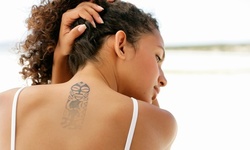 Unlimited Laser Tattoo-Removal Sessions at Sugar Land Laser Tattoo Removal (Up to 90% Off). Six Options.