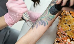 Three Laser Tattoo-Removal Sessions for up to 5, 12, or 15 Square Inches at LaserAway (Up to 89% Off)