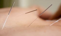 Consultation with One Acupuncture Treatments at Brightview Acuclinic (Up to 63% Off)