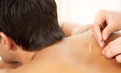 Up to 29% Off on Acupuncture Services at Bronx Community Wellness Center