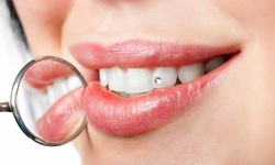 Up to 54% Off on Teeth Whitening - Traditional at Customeyez Ur Smile