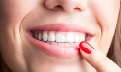 $1 for $75 Toward 60-Min In-Office Teeth-Whitening Treatment with Take-Home Kit at Smile Experts Dental