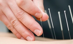 One or Three Acupuncture Treatments at Xu Shi Acupuncture (Up to 72% Off)